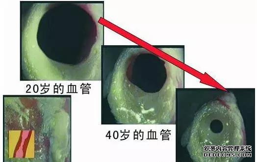 揭露“三高”真相：高血壓、高血脂、高血糖