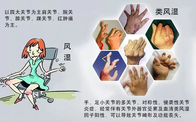 這些病癥你中了幾項？超過4項患類風(fēng)濕性關(guān)節(jié)炎的幾率極高